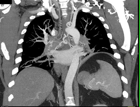 Occlusion Descending Thoracic Aortic Occlusion With Collaterals Chest