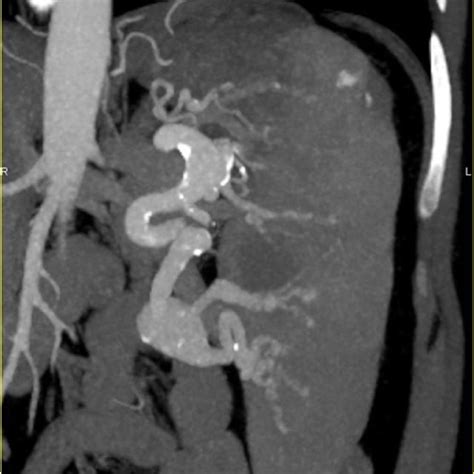 Calcification Of The Splenic Artery Due To Arteriosclerosis Is