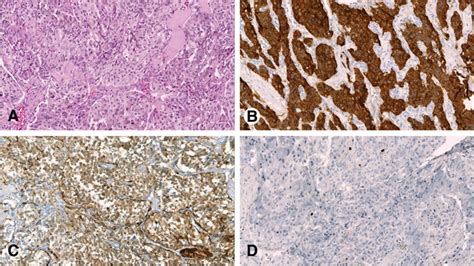 A Histological Aspect Of Tumor With Confluent Nests Of Polygonal