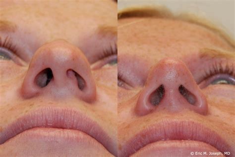 Eric M Joseph Md Rhinoplasty Before And After Deviated Septum Correction