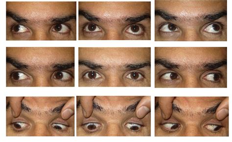 Trochlear Nerve Palsy Eye Position