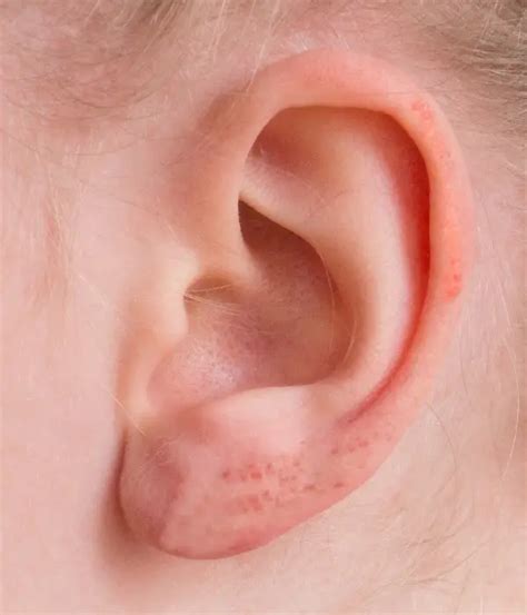 Complete Ear Eczema Guide Causes Symptoms Treatments And More