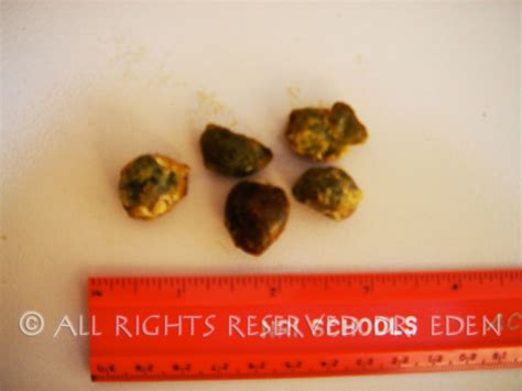 Gallstone Pictures Gallery See Images Of Real Gallstones Passed