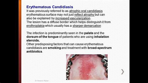 Red And White Lesions Of The Oral Mucosa Lec 1 Youtube