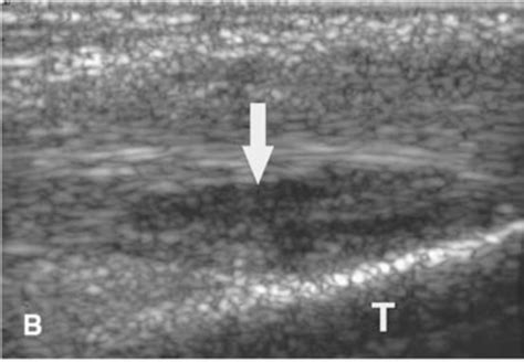 Figure From Characteristic Of Posterior Tibialis Tendon Dysfunction And Adult Acquired