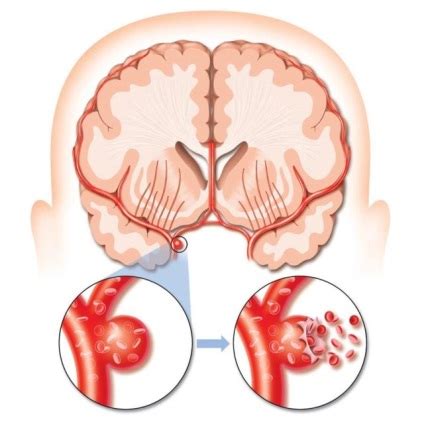 Clasificarea Accident Vascular Cerebral Ischemic Cauze Simptome