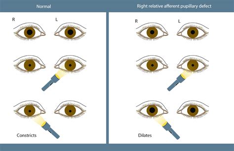 How To Examine The Pupil Eyeguru