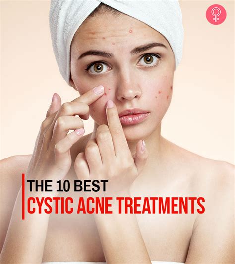 12 Best Cystic Acne Treatments That Work Like A Charm 2022