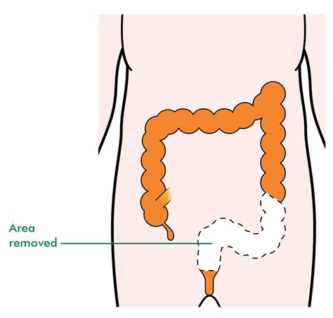 Types Of Surgery For Rectal Cancer Information And Support