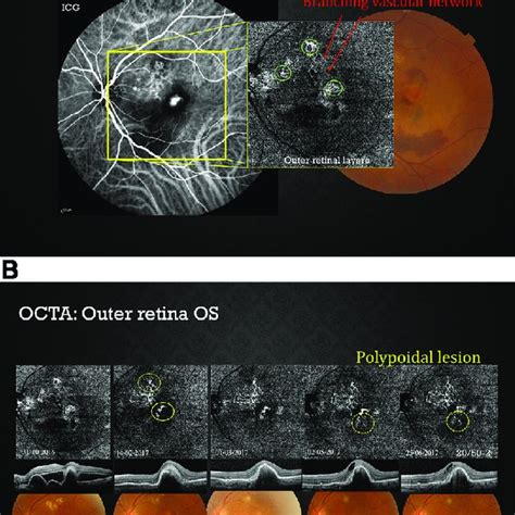 Bevacizumab And Ranibizumab For Pcv Visual Acuity Optical Coherence