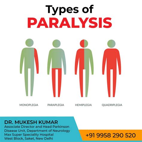Paralysis Specialist And Best Brain Stroke Doctor In Delhi