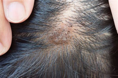 Dermatitis In Hair Or Skin Disease On The Head Stock Image Image Of