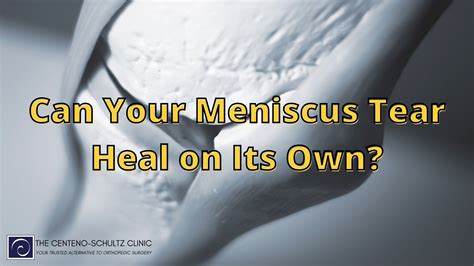 How To Heal A Torn Meniscus Naturally 2023