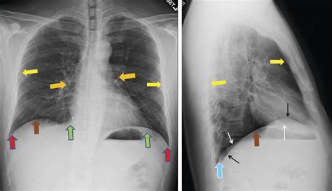 Chest X Ray Anatomy Pleura And Pleural Spaces Vrogue Co