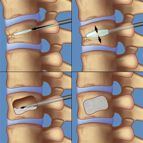 Kyphoplasty Utah Spine Specialists