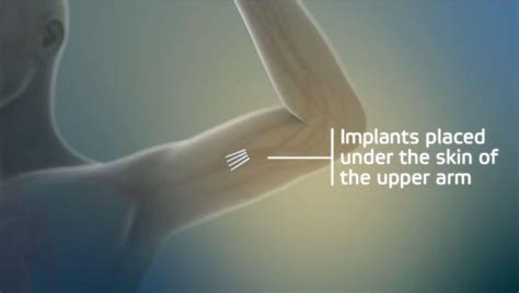 New Addiction Treatment Implant Will Hit The Market Next Month At