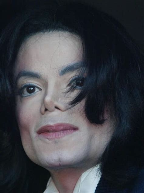 Vitiligo Michael Jacksons Skin Condition Skin Care Geeks