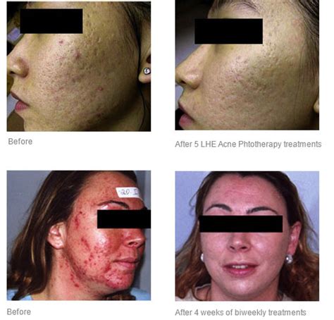 Lhe Acne Phototherapy Toronto Pure Rejuvenation Anti Aging And Laser