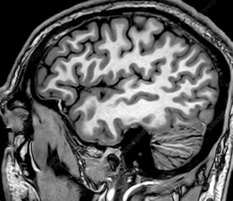 Normal Sagittal T1 Mri Brain 2 Stock Image C0393732 Science