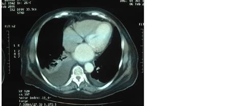 Mediastinal Metastasis 10 Years After Primary Renal Cell Carcinoma—a