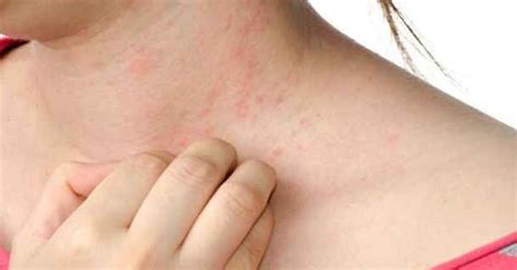 Skin Rash On Neck Pictures How To Choose And Use The Best Moisturizer