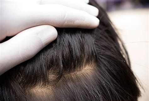 Common Signs Of Lice Head Lice Symptoms Treatment Ph