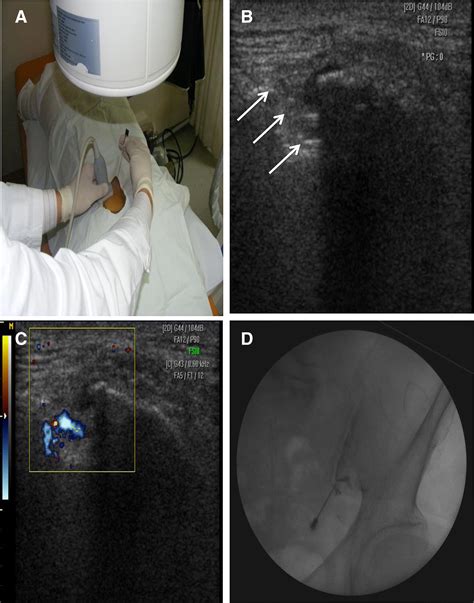 Ultrasound Guided Versus Fluoroscopy Guided Sacroiliac Joint Intra Articular Injections In The