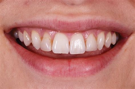 Evolution Of Treating Maxillary Lateral Incisors Decisions In Dentistry