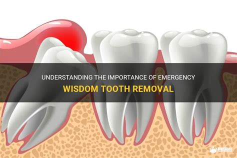 Understanding The Importance Of Emergency Wisdom Tooth Removal Medshun