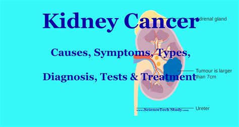 Kidney Cancer Symptoms Causes Diagnosis And Treatment