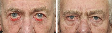 6 Lower Eyelid Ectropion Plastic Surgery Key