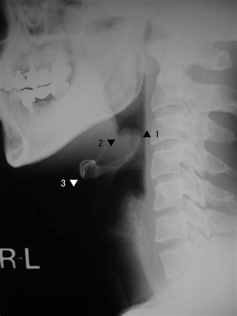 Tenderness Over The Hyoid Bone Can Indicate Epiglottitis In Adults