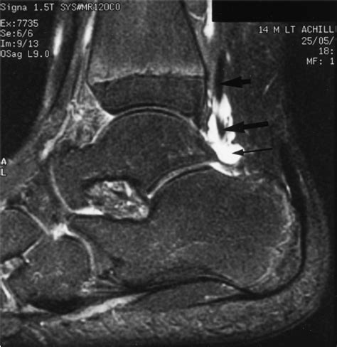 Indications for foot mri scan. Axial T2 MRI image showing fluid within the flexor hallucis longus... | Download Scientific Diagram
