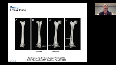 Distal Femoral Osteotomy Indications Planning And Surgical Technique
