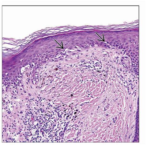 List 105 Pictures Photos Of Melanoma In Situ Latest