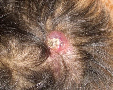 Erythematous Nodule With A Superficial Crust On The Scalp Download