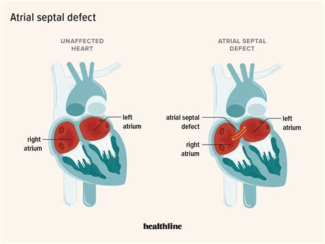 Atrial Septal Defect Definition Causes Treatment Outlook Hot Sex Picture