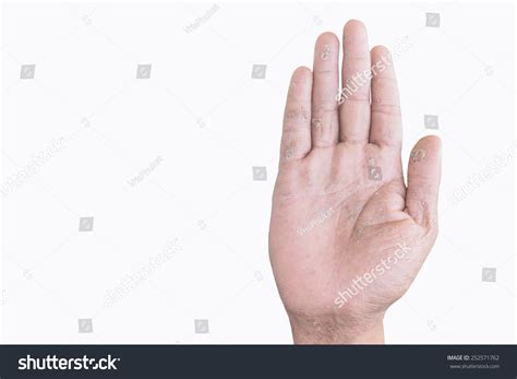 Two Male Palms Eczema Isolated On Stock Photo Edit Now 252571762