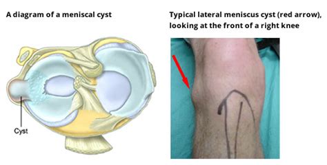 Meniscal Cartilage Tears And Injuries Symptoms Diagnosis And Treatments