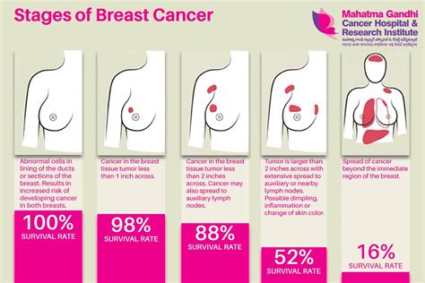 Symptoms And Complications To Understanding Breast Cancer Fundacionhenrydunant Org
