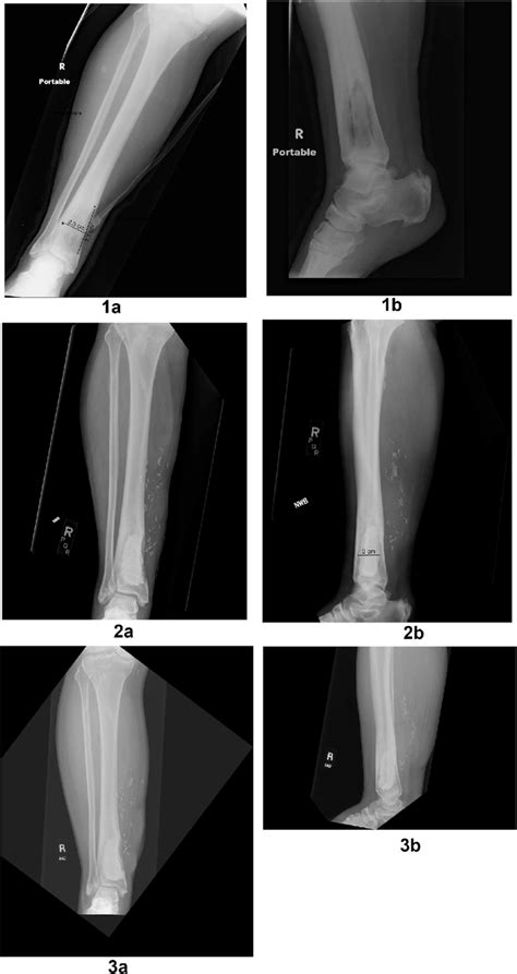 Ap And Lateral Radiographs Of The Distal Tibia Taken Preoperatively