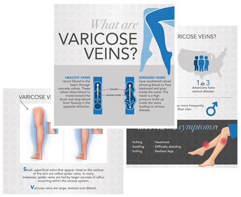 Varicose Vein Treatment Utah Ivc