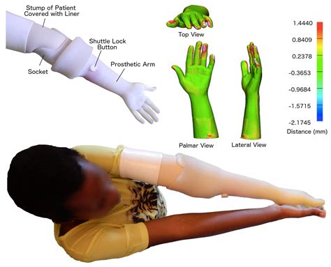 A Method For 3 D Printing Patient Specific Prosthetic Arms With High