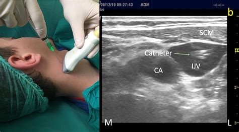 A Novel Method For Ultrasound Guided Central Catheter Placement