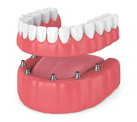 Types Of Dentures And Their Costs Complete Denture Care Tips