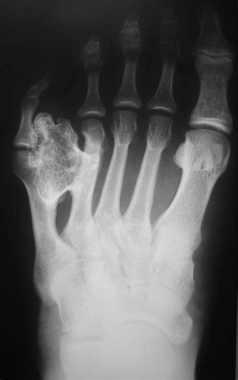 Giant Solitary Osteochondroma Arising From The Fifth Metatarsal Bone A Case Report The