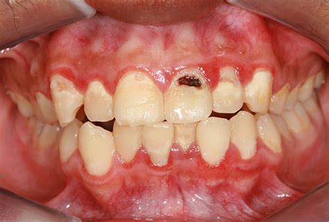 Oral Cancer Risk May Be Increased By Gum Disease Bacteria DOCS Education DOCS Education