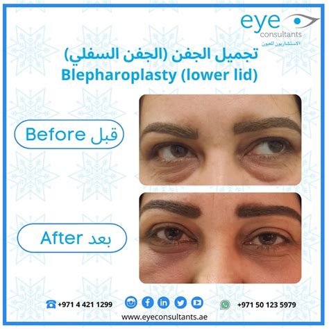 Best Oculoplastic Surgeon In Dubai Blepharoplasty