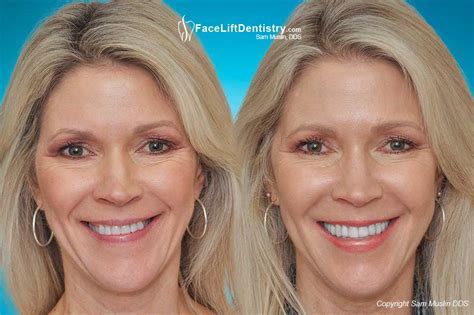 Unfortunately, many people think that the only way to fix an underbite is to have surgery. Before and After Photos: Underbite, Overbite, Open Bite
