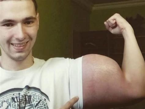 Russian Teen Shows Insane Amount Of Synthol In His Arms Fitness Volt